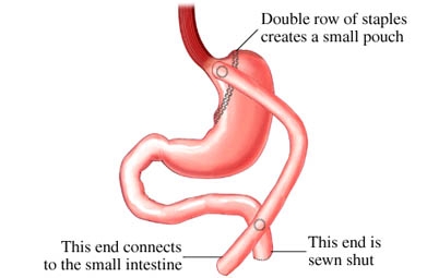 Bypass intestinal